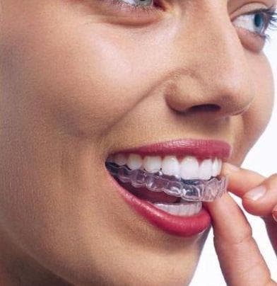 Ortodoncia sin brakets